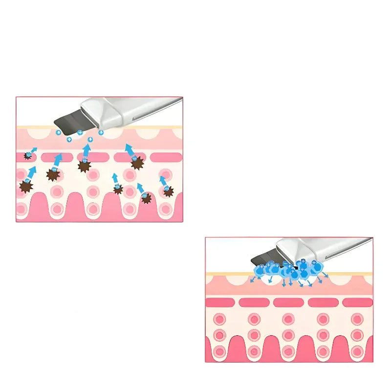 Ultraschall-Gesichtshautwäscher Reiniger Mitesser Akne Entfernung Gesichts-Spa-Vibrationsmassagegerät Ultraschall-Peeling Schönheitsgerät