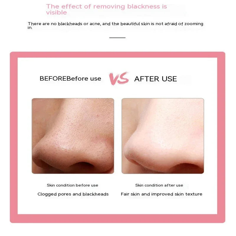 Instrument ergonomique de beauté pour le visage, éliminateur de points noirs et d'acné