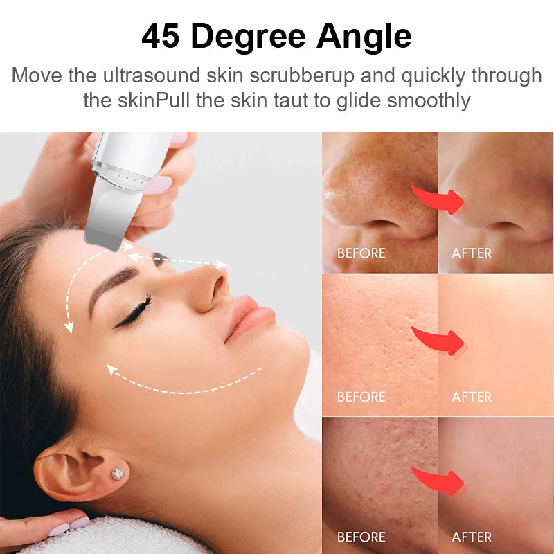 Nettoyant Facial Ultrasonique Vibrations Éliminateur de Points Noirs